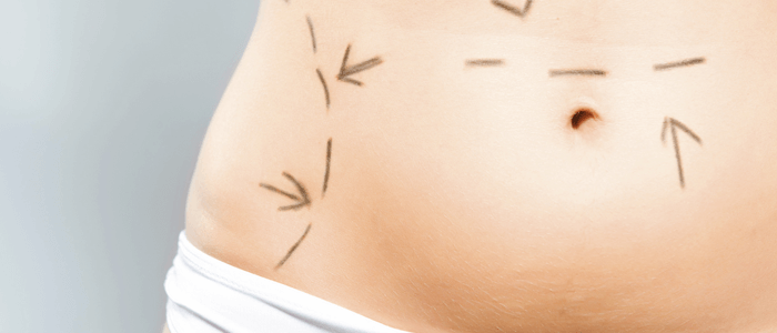 marcações de cirurgia plástica no corpo de uma mulher