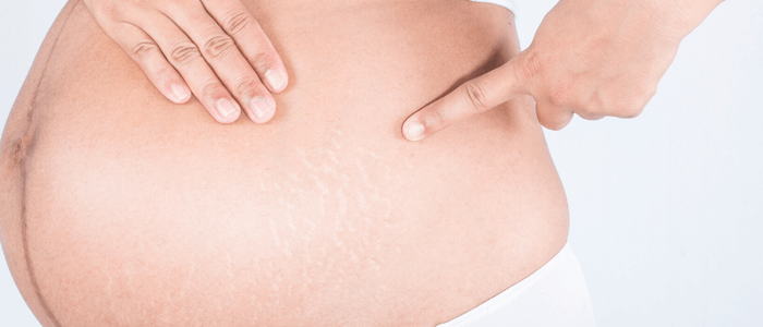 mulher grávida com estrias na barriga - gravidez